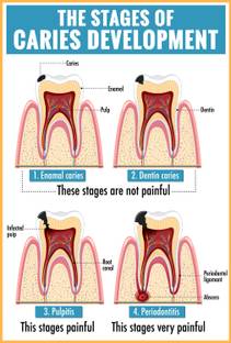 ShubhFly 48 cm Stages of Caries Development Chart for Dental Clinic Poster Self Adhesive Sticker