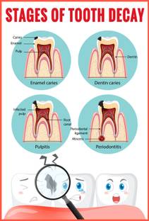 ShubhFly 48 cm Stages Of Tooth Decay Chart for Dental Clinic Poster Self Adhesive Sticker