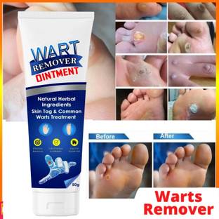 klyish Wart Remover Cream - Remove Warts and Tags Painlessly, Rapid Action, Inside-out Men & Women