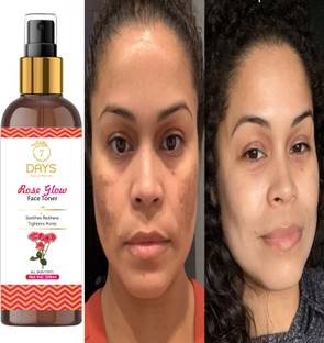7days natural Rose Water Glow Toner� Scar removing Reduces Dark Circles, Acne & Blemishes Men & Women