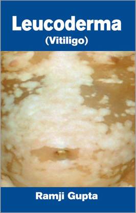 Leucoderma Vitiligo 01 Edition