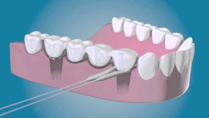 TePe Bridge and Implant Floss - 5 Pack