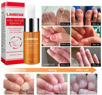 LANBENA Nail Repair Essence (Anti-Fungal) - Remove Onychomycosis - Nail Repair, Whitening & Treatment Antiseptic Liquid