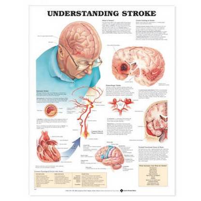 Understanding Stroke Anatomical Chart