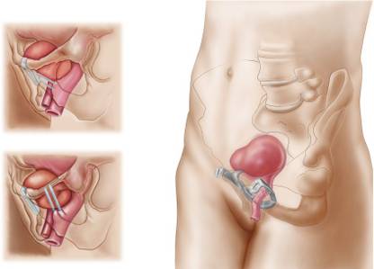 Anatomy of bladder suspension procedure for urinary incontinence Canvas Art - Stocktrek Images (36 x 22) Canvas Art