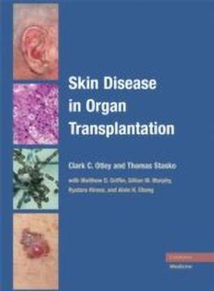Skin Disease in Organ Transplantation