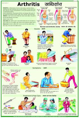 Arthritis Chart Photographic Paper