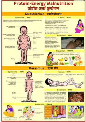 Protein Deficiency Chart ( Kwashiorkar & Marasmus ) Photographic Paper