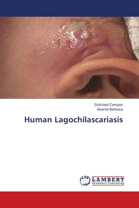 Human Lagochilascariasis