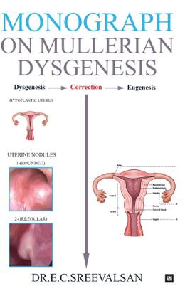 Monograph on Mullerian Dysgenesis