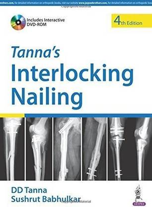 Tanna's Interlocking Nailing