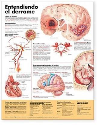 Understanding Stroke Anatomical Chart in Spanish (Entendiendo que es un derrame)