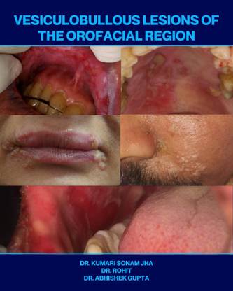 Vesiculobullous Lesions of the Orofacial Region