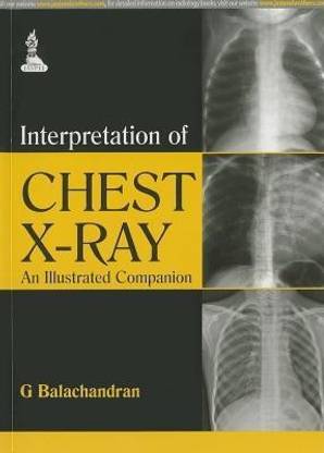 Interpretation of Chest X-Ray