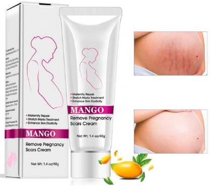 RtopR mango remove pregnancy stretch marks scars cream
