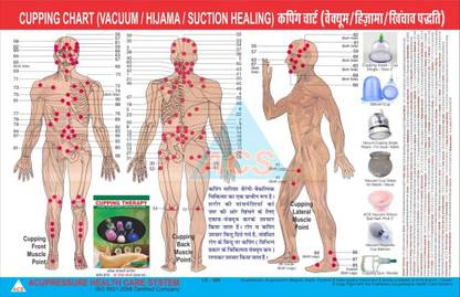 Cupping Therapy Chart - Hijama / Vacuum Paper Print