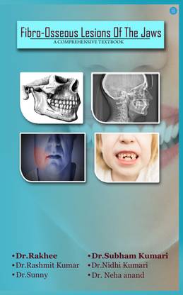 Fibro Osseus Lesion Of The Jaw