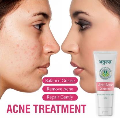 Atulya Ayurveda Anti Acne Cream for Active/Cystic Acne , Remove Pimple , Treatment for Face Glow