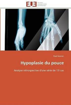 Hypoplasie du pouce