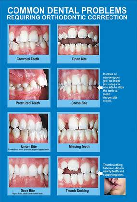 Poster Dental Doctor Poster Orthodontic Correction Dental Problems Large Poster (36 X 24 Inch, Multicolour) Fine Art Print