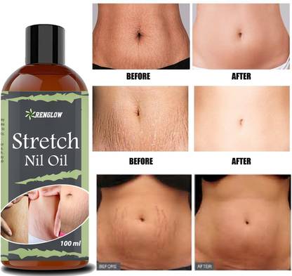 RENGLOW Stretch mark removal cream oil Men, Stretch Mark, Ageing, Uneven Skin Tone
