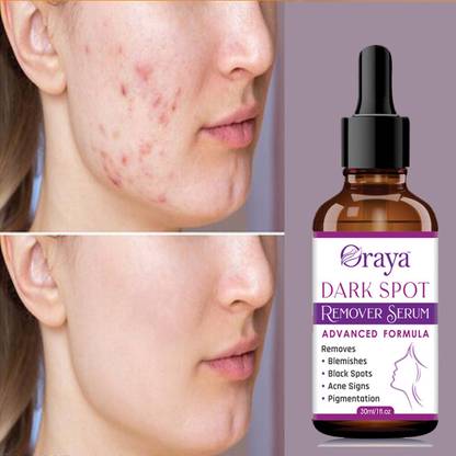 Oraya Dark Spot Remover Serum, Pimple Marks, Acne Scar, Pigmentation & Blemish-