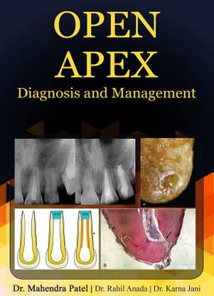 OPEN APEX Diagnosis and Management