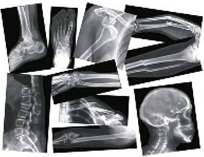 Roylco R-5914 Broken Bone Compound Fracture X-Rays