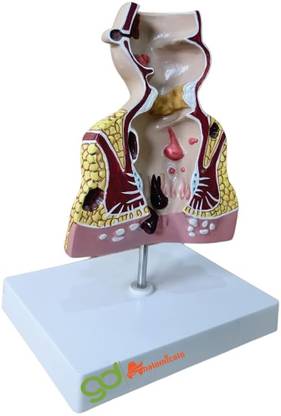 GD ANATOMICALS Human Body Anatomy Rectum Model with Common Pathologies Tool 17 x 13 x 23 cm Anatomical Body Model