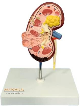 GD ANATOMICALS Kidney Model with Pathologies - Educational Anatomy Tool Anatomical Body Model