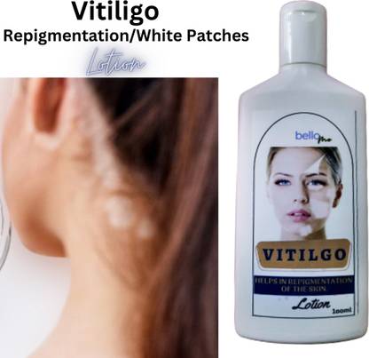 BelloMe Best Ayurvedic Leucoderma Treatment | Vitiligo Lotion For White Patches |