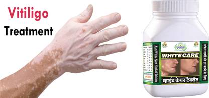 Gunmala Whitecare Tablets For Effective Vitiligo & Leucoderma Treatment
