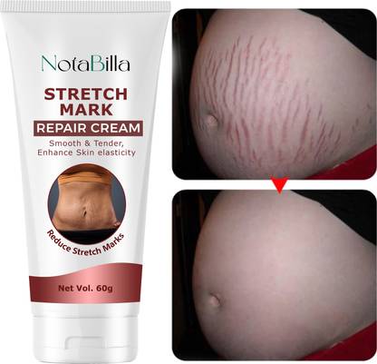 Notabilla Stretch Mark Cream ,For Pregnancy to Reduce Stretch Marks & Scars