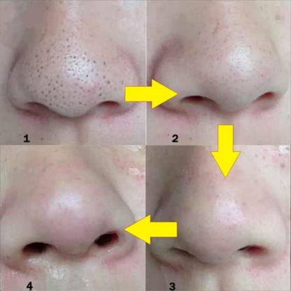 Emijun Deep Cleansing Pore Strips, Nose Strips for Blackhead Removal ( 10Strips)