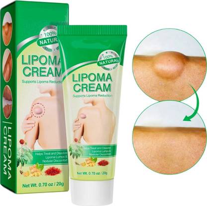 SIYDHA Lipoma Cream Original Lipoma Dissol Ving Cream