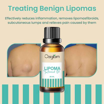 Oziglam Lipoma Removal Oil for Treatment Of Lipoma Dissolving Fat Medicine