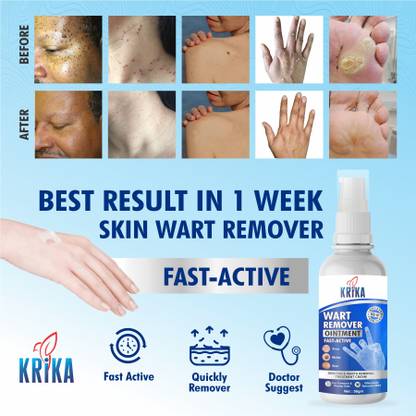 krika WART REMOVER OINTMENT TREATMENT