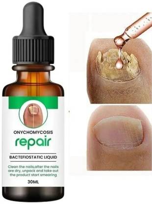 GABANA NAIL SERUM FOR NAIL GROWTH & REPAIR, FUNGAL INFECTION (30ml) Pack of 1