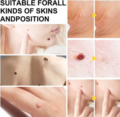 GFSU - GO FOR SOMETHING UNIQUE Warts of Instant Blemish Removal Cream, Wart Remover Ointment for All Skin Types