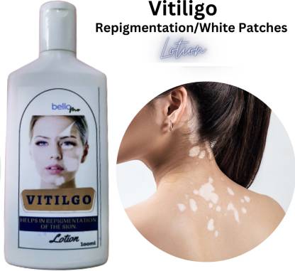 BelloMe Ayurvedic Leucoderma Treatment | Vitiligo Lotion For White Patches |