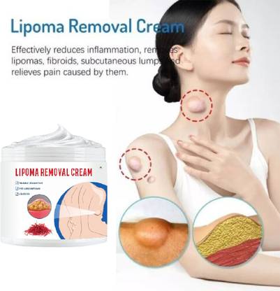 ONEAL Lipoma Removal Cream Portable Easy to Use for Whole Body fat in the body (1 Pcs)