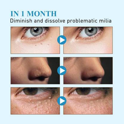 BNF Milia Remover Patch Sticker Moisturize Clean Skin For Fat Granules Eye