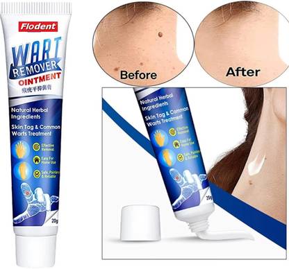 Acno Wart remover cream