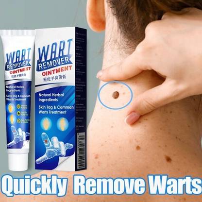 WOONGMI Warts Remover Cream Foot Corns Remover Cream remove calluses