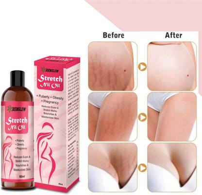 RENGLOW Stretch Nil Oil - for Scar And Stretch Mark Reduction After Pregnancy,Puberty