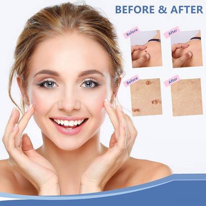 REIMICHI Warts of Instant Removal Cream, Wart Remover Gel for All Skin Types