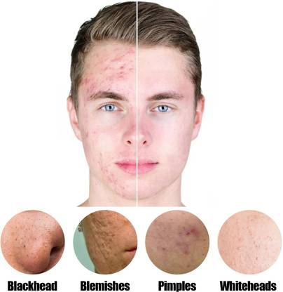 ADJD Skin Care Face Whitening Cream Moisturizing Oil Control Acne Remover