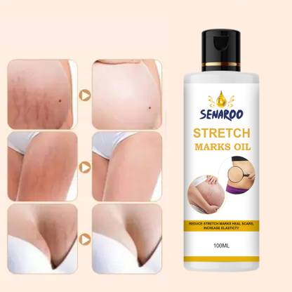 SENAROO Body stretch mark removal Oil teenage stretch marks solutions naturally