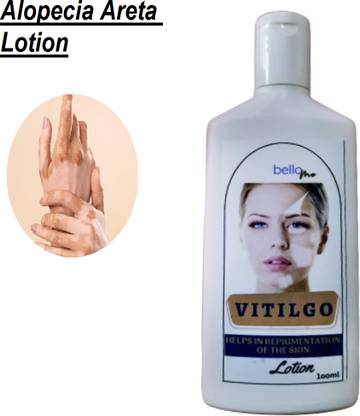 BelloMe Vitilgo Ayurveda For Leukoderma ( Cure White Patches On The Skin )