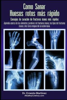 Como curar huesos rotos mas rapido. Consejos para curar fracturas de huesos